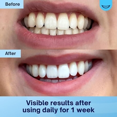 Teeth whitening gel - whitening, pen